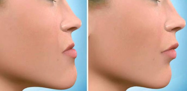 Deformidade facial: o que é e como tratar?