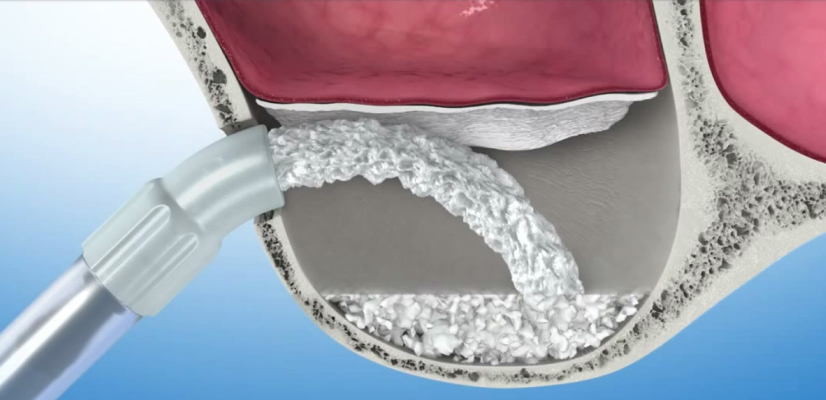Enxerto ósseo: tudo que você precisa saber sobre esse tratamento odontológico.