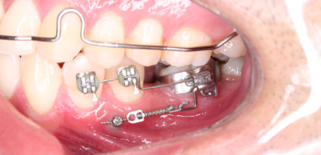 Implantes Ortodônticos: saiba mais sobre esse procedimento odontológico