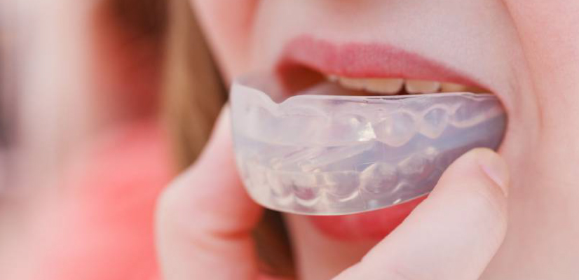 Protetor Bucal: conheça os tipos que existem.