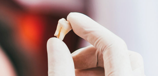 Você sabe por que os dentes são extraídos? Entenda as causas e consequências